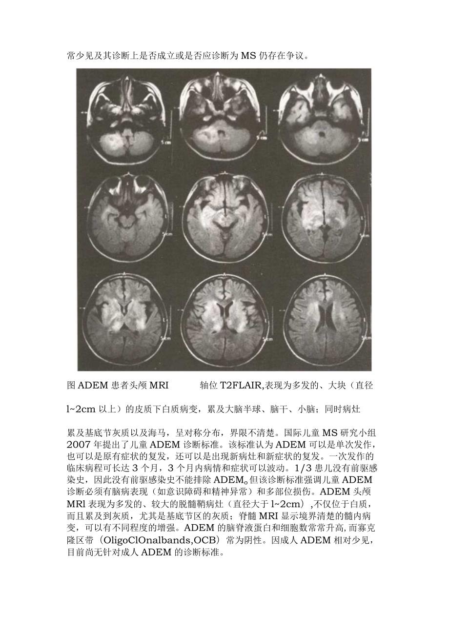 2024急性播散性脑脊髓炎.docx_第2页