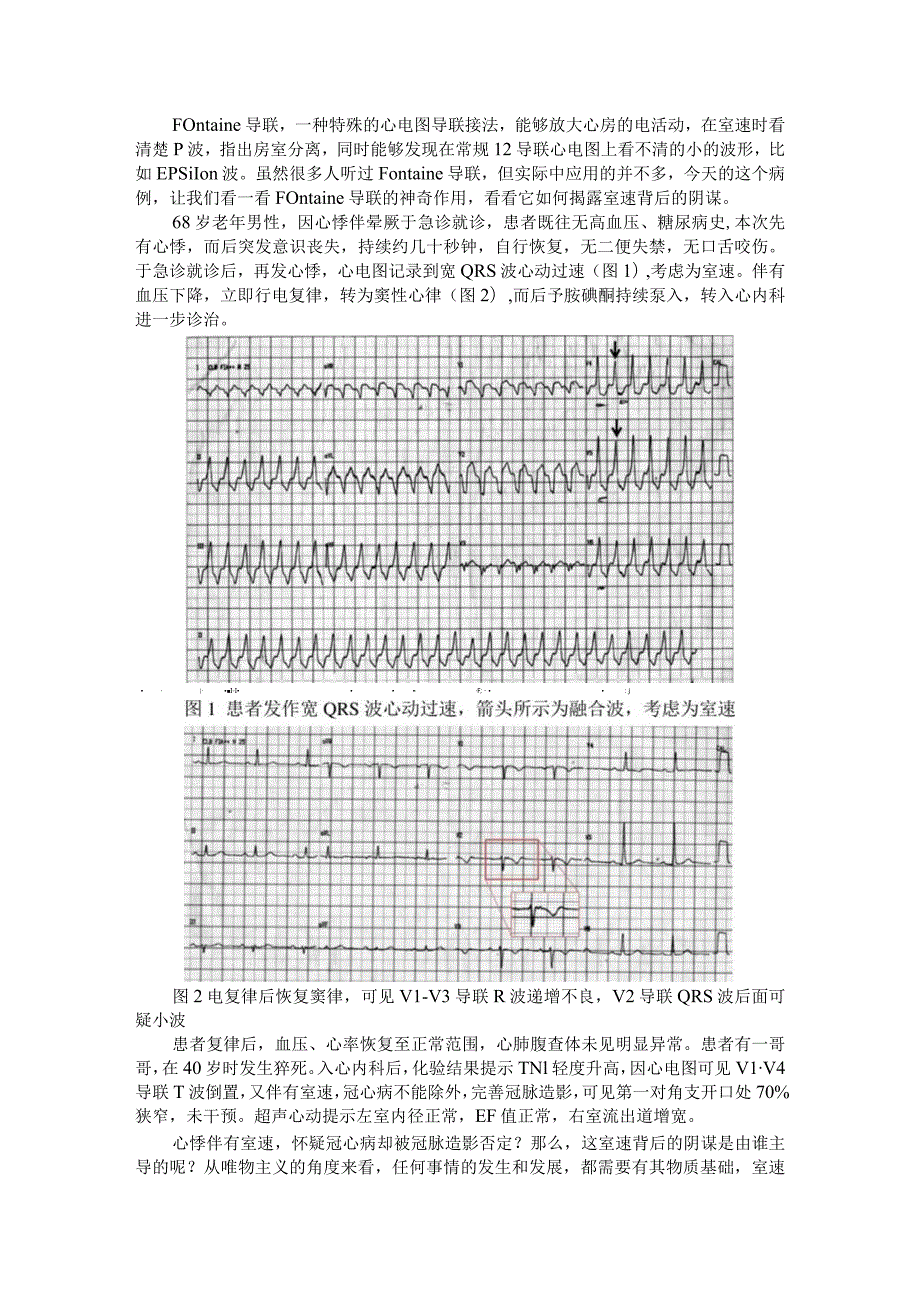 Fontaine导联显露室速背后原因（识图寻踪）.docx_第1页