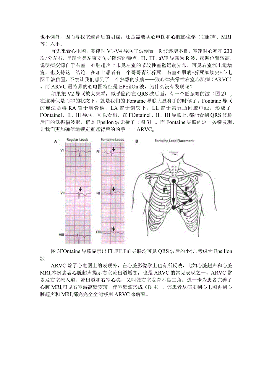 Fontaine导联显露室速背后原因（识图寻踪）.docx_第2页