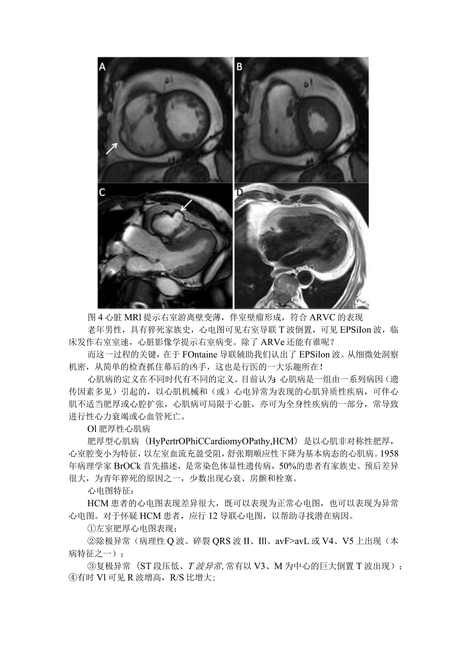 Fontaine导联显露室速背后原因（识图寻踪）.docx_第3页