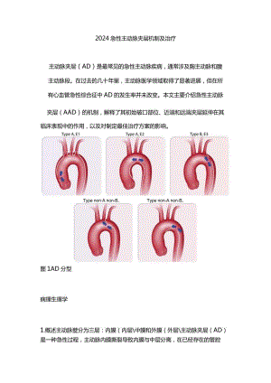 2024急性主动脉夹层机制及治疗.docx