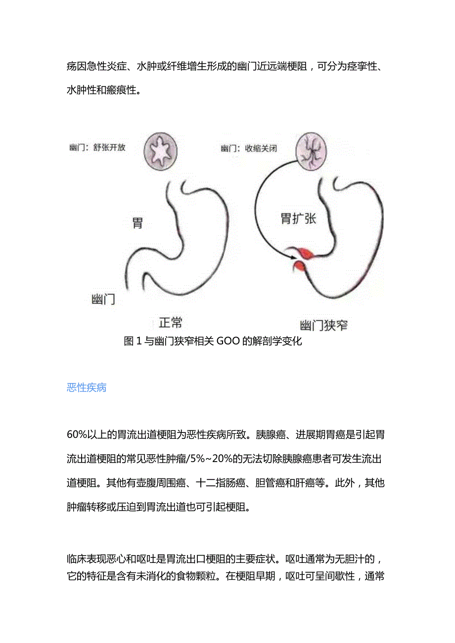 2024胃流出道梗阻的诊疗要点.docx_第2页