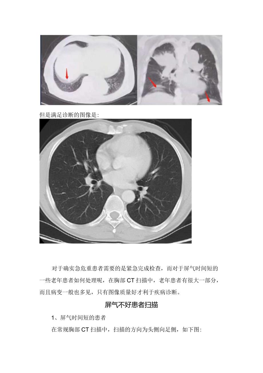 临床胸部CT扫描时屏气不好解决要点.docx_第2页