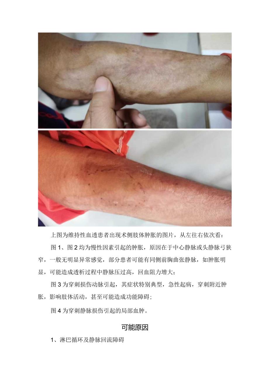 动静脉造瘘术后患者术侧肢体反复肿胀临床表现及可能原因.docx_第3页