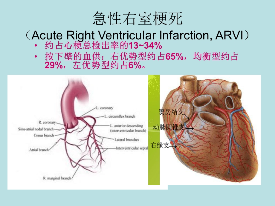 急性右室心肌梗死(AVRI)心电图表现及其鉴别诊断ppt演示文稿.ppt_第3页