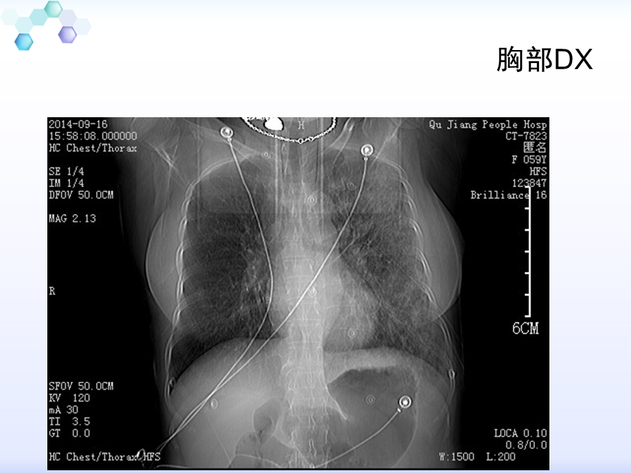 恶心呕吐伴寒战咳嗽病例分析.ppt_第3页