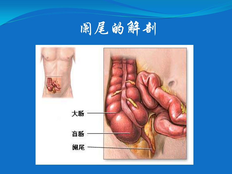 急性阑尾炎1.ppt_第3页