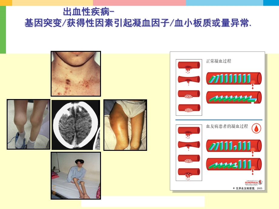 [精品]出血性疾病的诊断思路.ppt_第3页