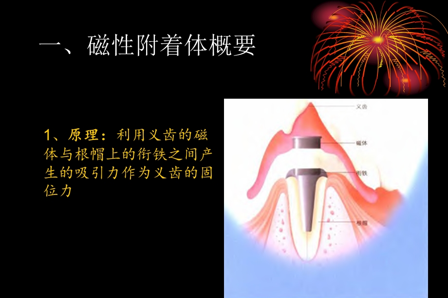 磁性附着体覆盖义齿的临床术式.ppt_第3页