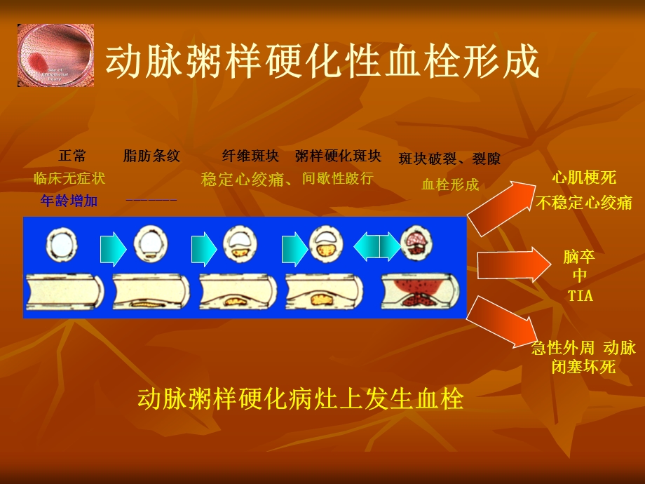 短暂性脑缺血发作2.ppt_第3页