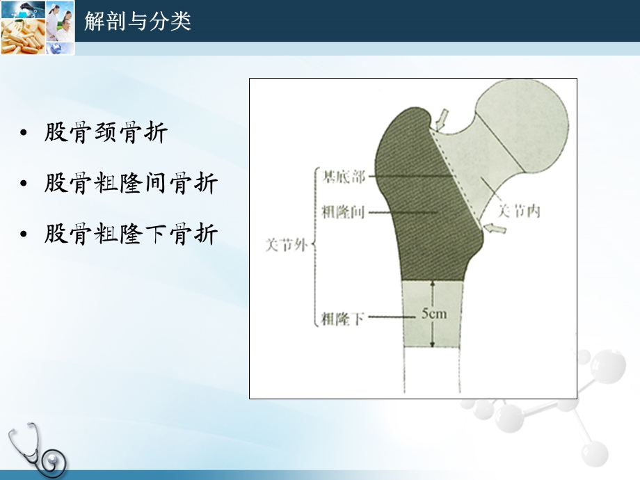 老股骨近端骨折的手术治疗.ppt_第2页