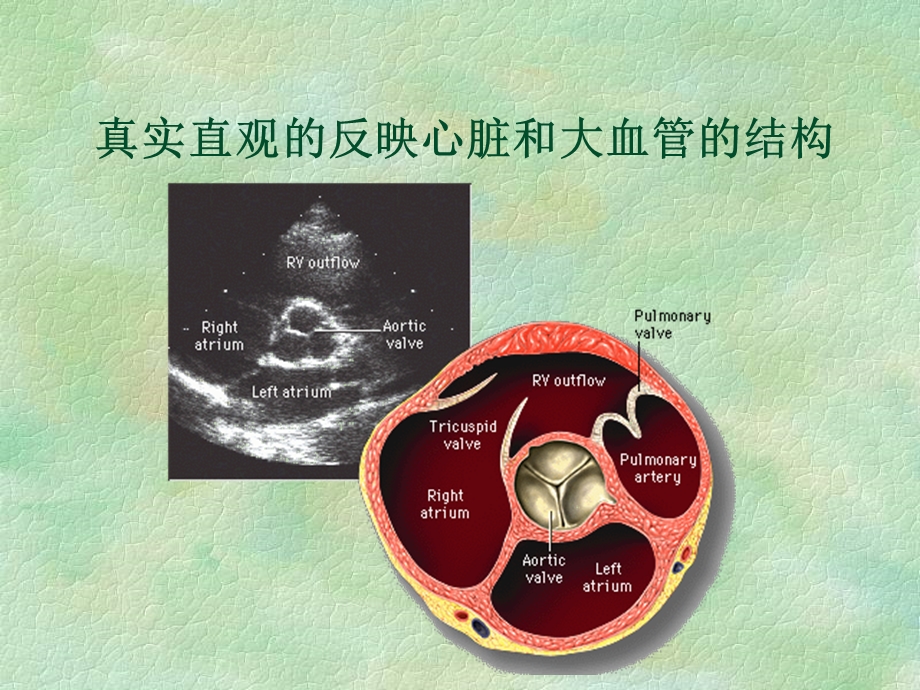 超声心动图在先天性心脏病诊疗中的应用.ppt_第3页