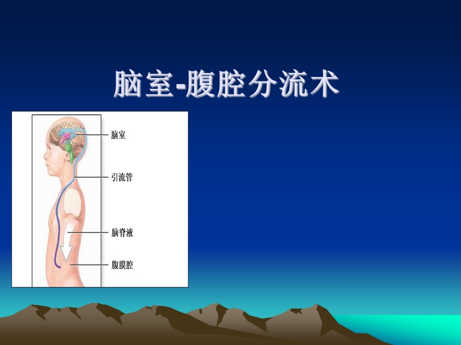 脑室腹腔分流术.ppt.ppt_第1页