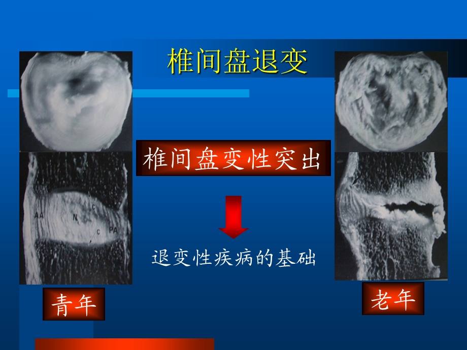 腰椎间盘突出症医学演示文稿.ppt_第2页