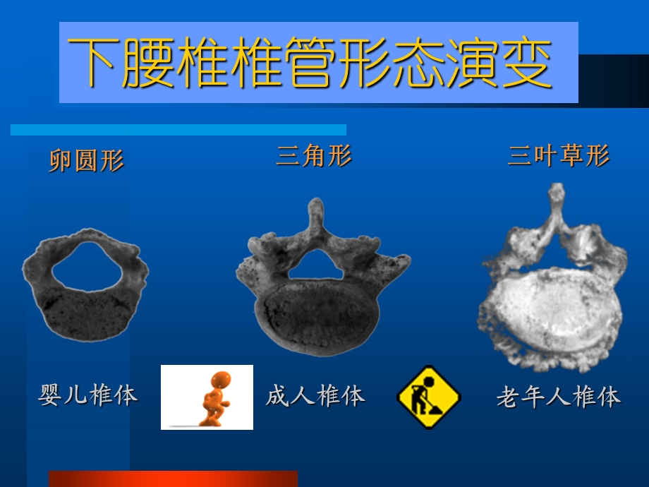 腰椎间盘突出症医学演示文稿.ppt_第3页