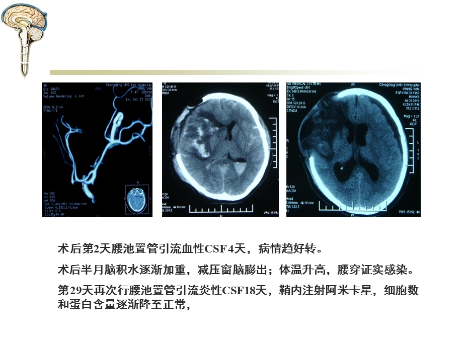 腰大池穿刺置管引流术.ppt_第3页