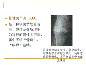 骨关节痹症(骨性关节炎).ppt.ppt