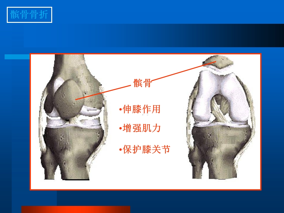 髌骨骨折专题教学讲座PPT.ppt_第3页