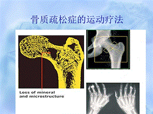 骨质疏松症的运动疗法.ppt