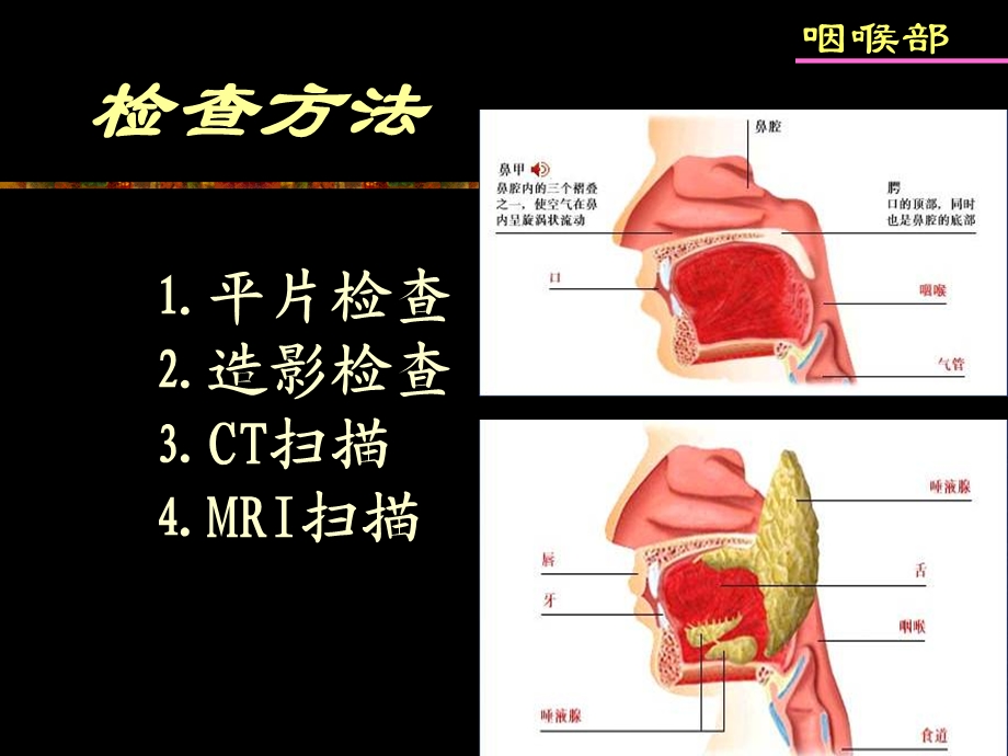 鼻咽及喉部影像诊断.ppt.ppt_第3页