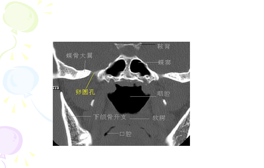 鼻窦病变CTppt.ppt_第3页