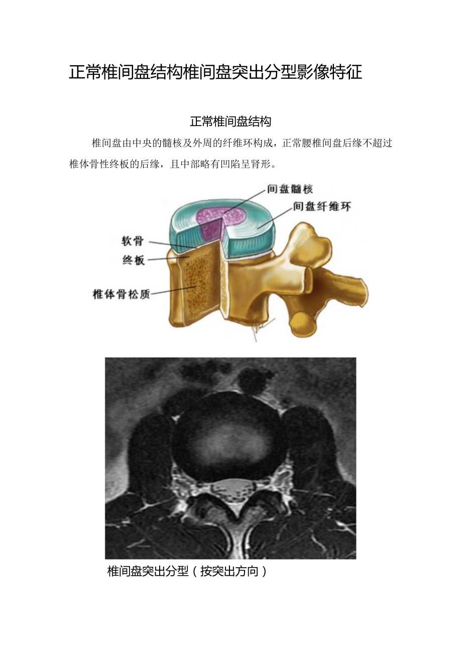 正常椎间盘结构椎间盘突出分型影像特征.docx_第1页