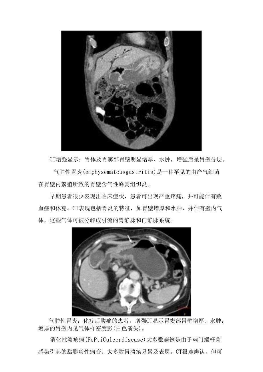 临床胃部CT扫描技术及炎性病变、梗阻性病变、穿孔性病变、血源性病变等急性胃痛CT表现.docx_第3页