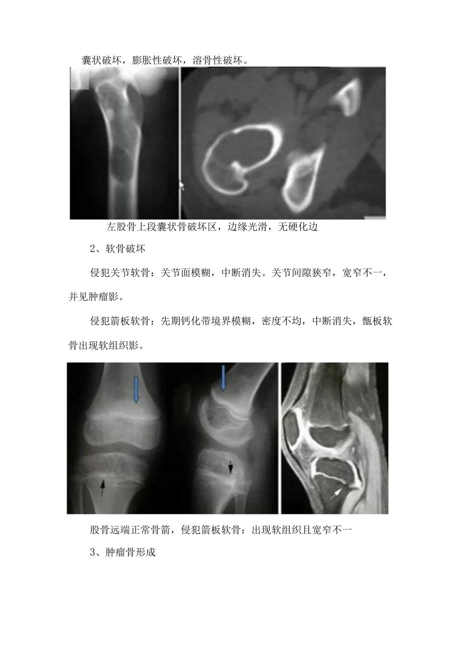 临床骨肿瘤病理、肿瘤判断、良恶性肿瘤判断及注意要点.docx_第2页