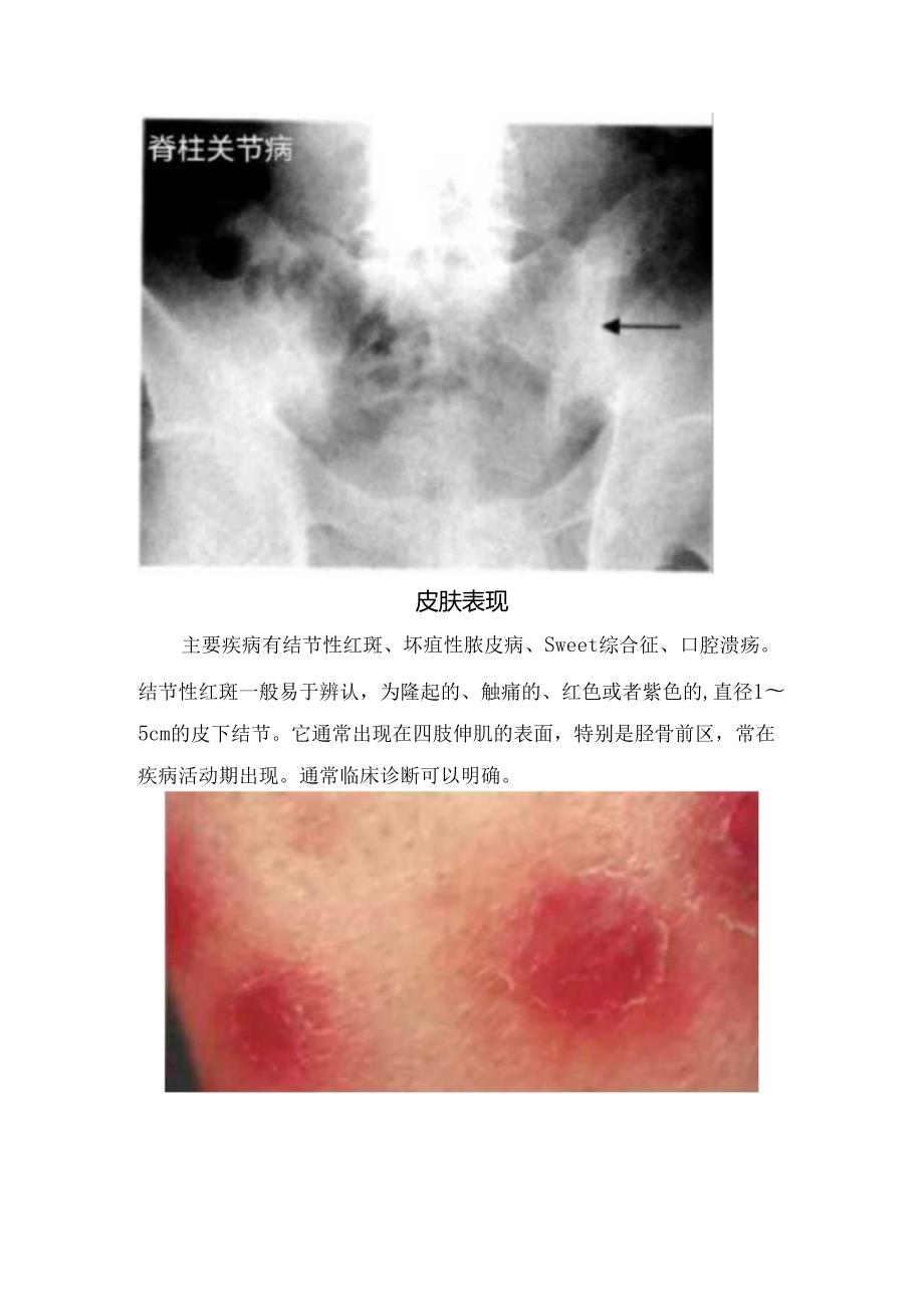 临床克罗恩病病理、临床表现及炎症性肠病关节、皮肤、肝胆、眼睛等肠外表现和注意识别.docx_第2页