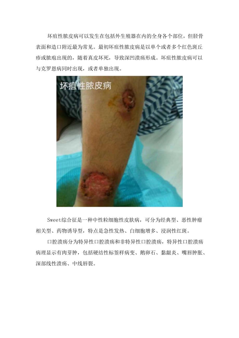 临床克罗恩病病理、临床表现及炎症性肠病关节、皮肤、肝胆、眼睛等肠外表现和注意识别.docx_第3页