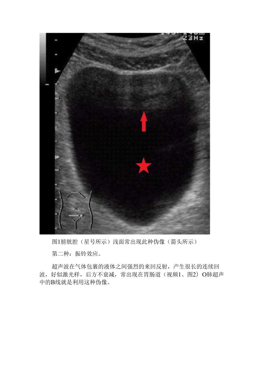 临床肺部结构及多重反射、振铃效应等超声伪像.docx_第2页