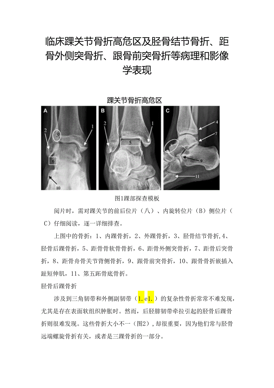 临床踝关节骨折高危区及胫骨结节骨折、距骨外侧突骨折、跟骨前突骨折等病理和影像学表现.docx_第1页