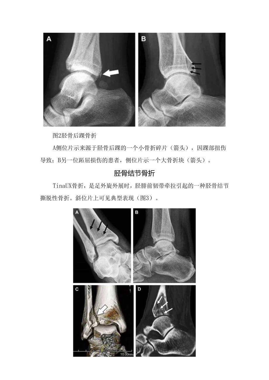 临床踝关节骨折高危区及胫骨结节骨折、距骨外侧突骨折、跟骨前突骨折等病理和影像学表现.docx_第2页