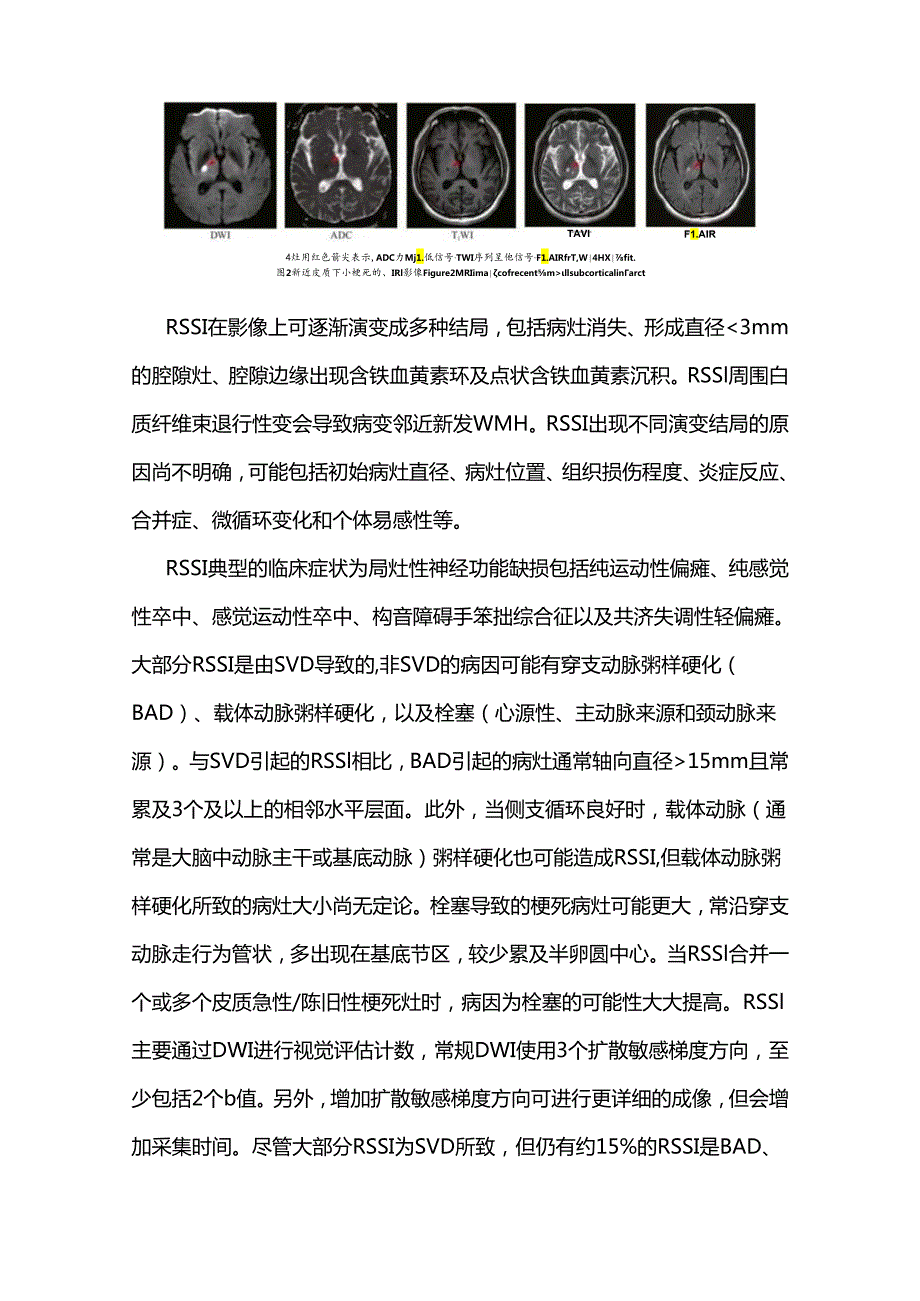 中国脑小血管病的神经影像学诊断标准及名词标准化定义2024.docx_第3页