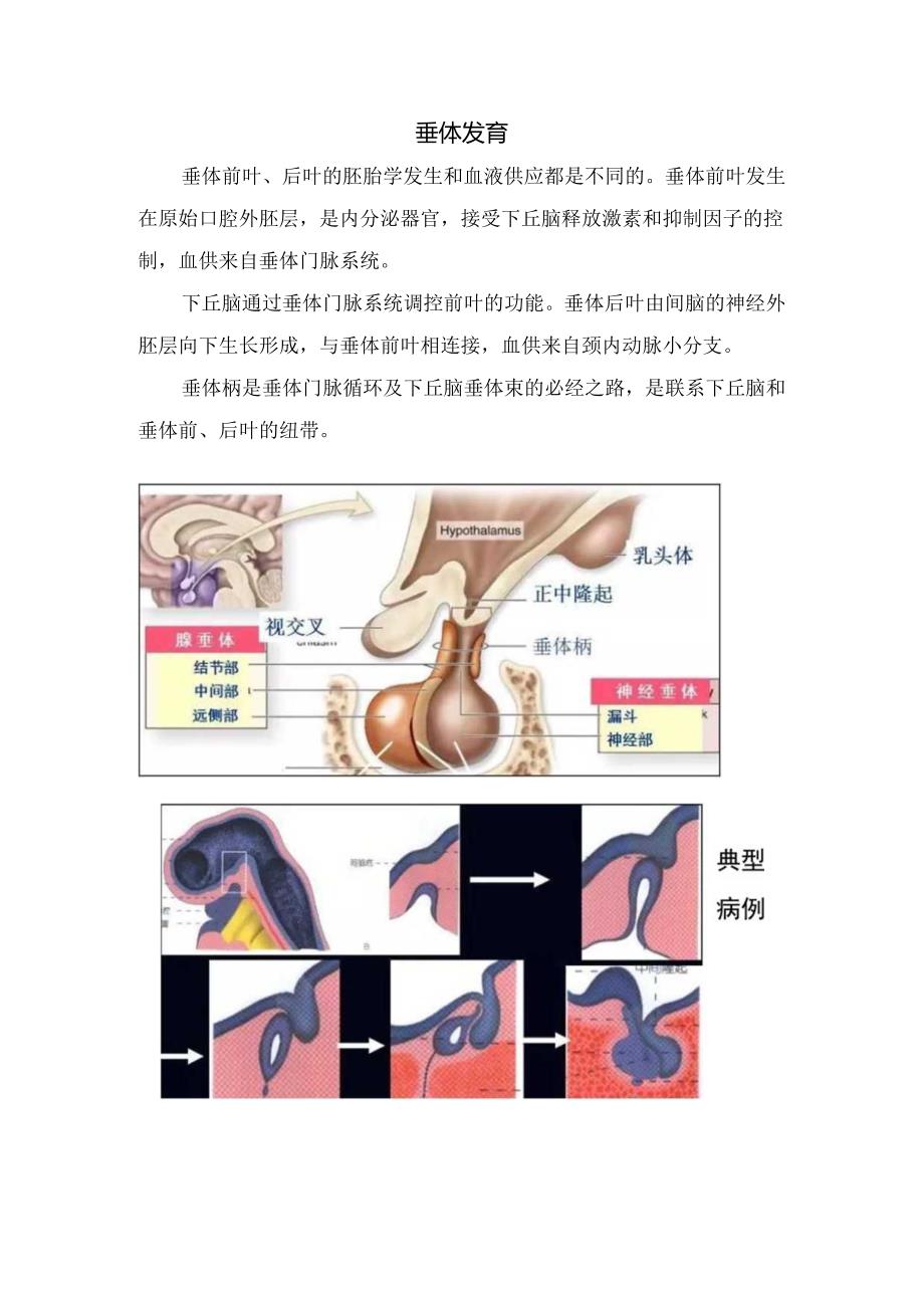 临床垂体柄阻断综合征概述、发病机制、临床表现、影像表现、垂体发育及典型病例.docx_第2页