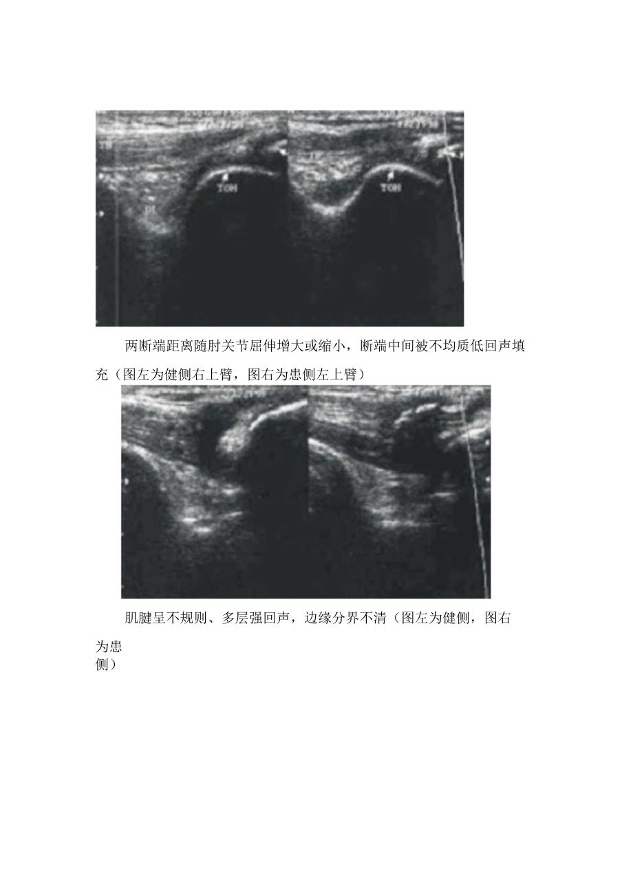 临床肱三头肌主要作用及肱三头肌肌腱断裂伴骨化性肌炎超声诊断.docx_第2页