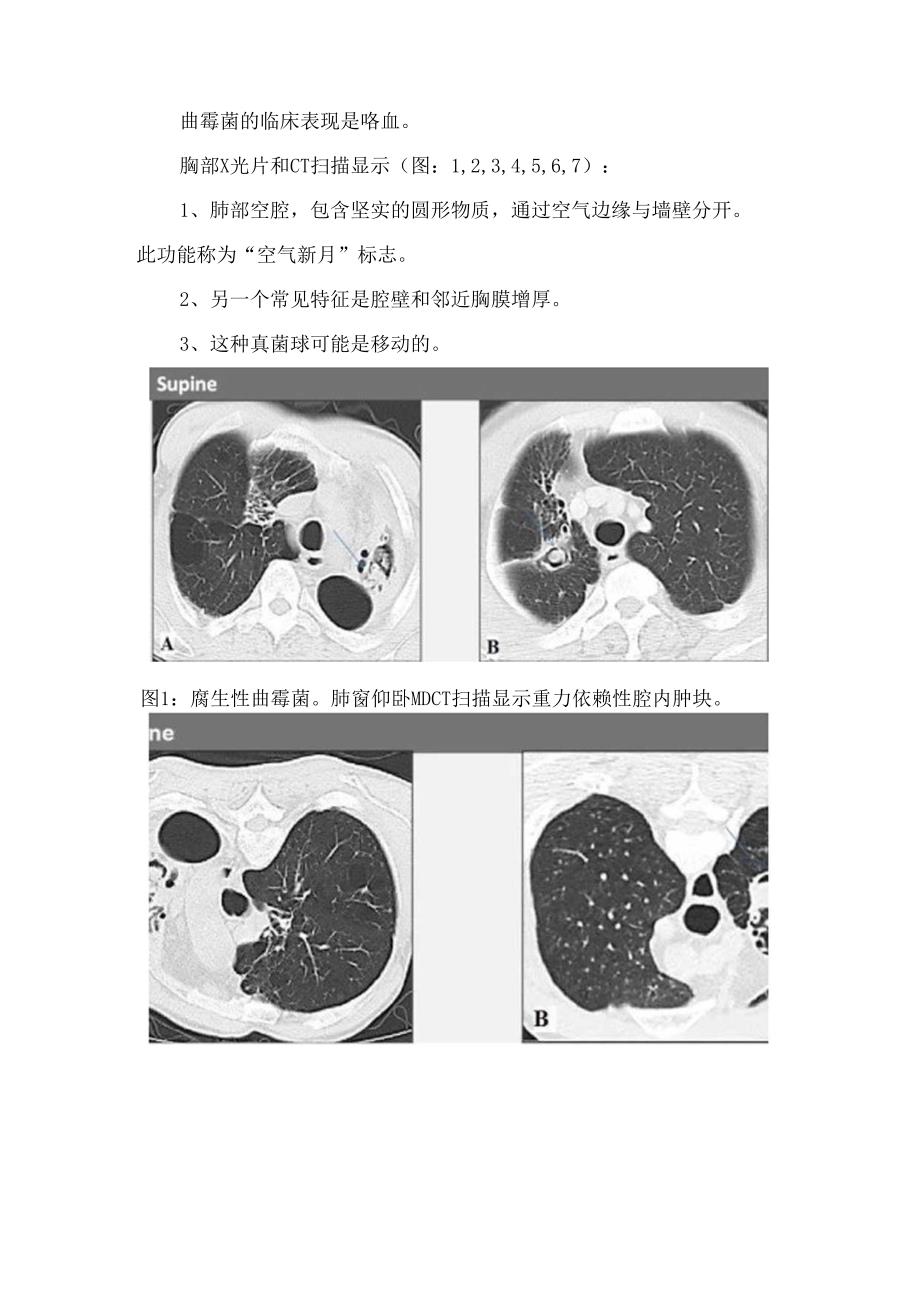 临床曲霉菌、过敏性支气管肺曲霉菌病、半侵入性或慢性坏死性曲霉菌病、侵袭性曲霉菌病等肺曲霉菌病影像表现及鉴别诊断.docx_第2页