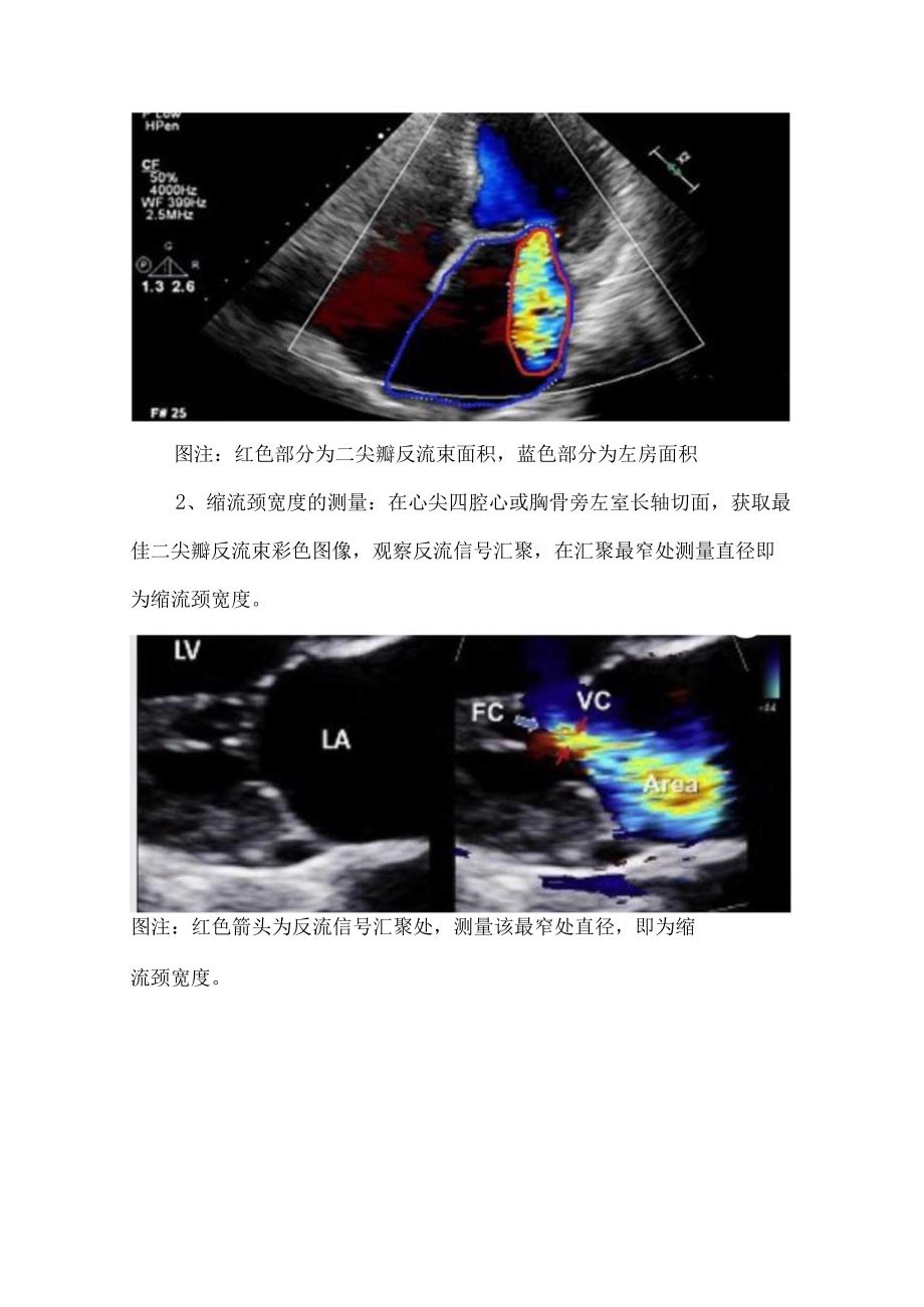 二尖瓣反流程度分级标准（中国专家共识版）.docx_第3页