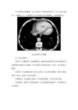 临床心脏增大、心包异常、肺循环异常等循环系统基本病变影像学表现.docx