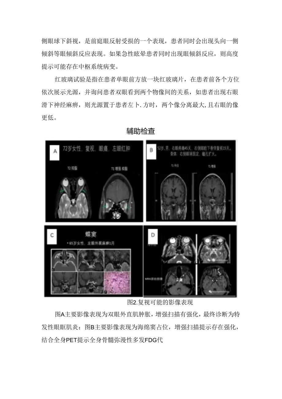 临床复视定义、诊断思路、体格检查方式及辅助检查.docx_第2页