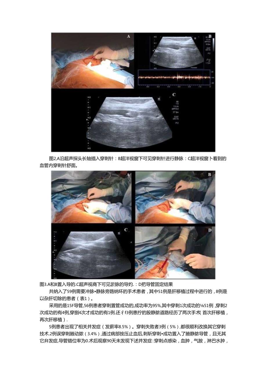 超声引导腋静脉穿刺置管术（超声引导经腋静脉穿刺中心静脉置管临床应用）.docx_第2页