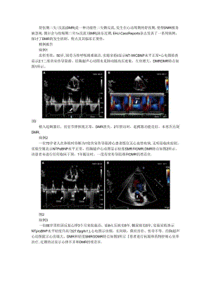 从系列病例探讨舒张期二尖瓣反流的机制及特点.docx