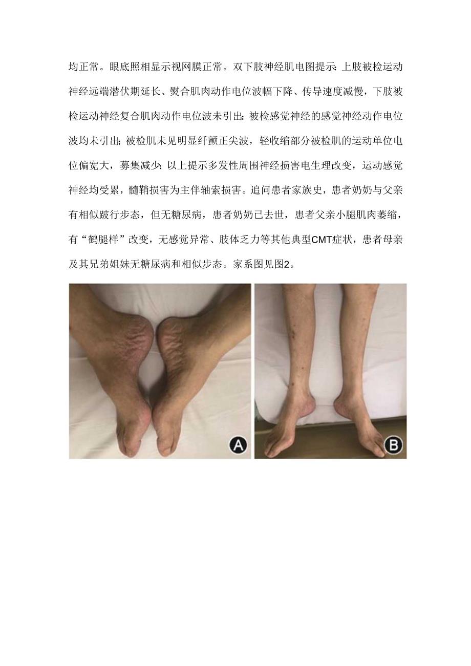 2型糖尿病伴腓骨肌萎缩症1例【病例报告】.docx_第3页